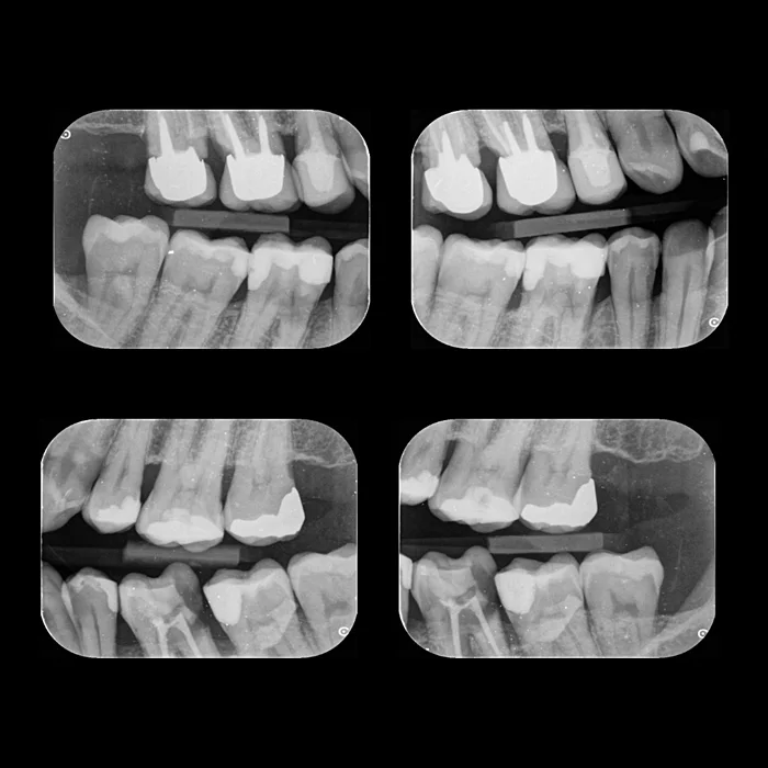 radiografia interproximal + radiologia odontologica + sao paulo + uniradiographic