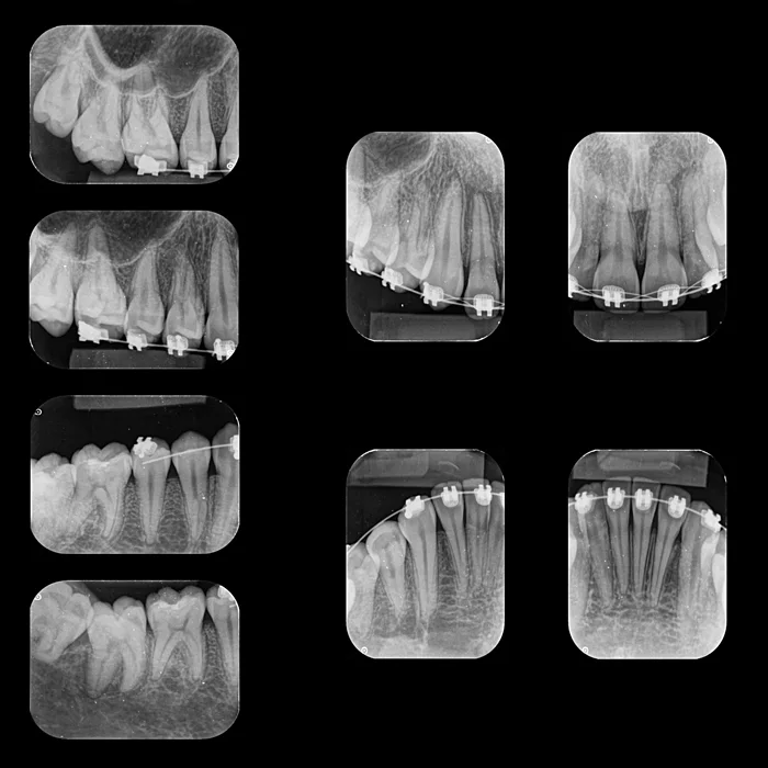 radiografia periapical + radiologia odontologica + sao paulo + uniradiographic