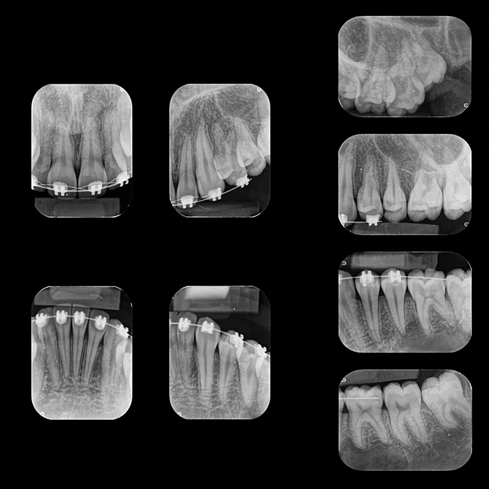 radiografia periapical + radiologia odontologica + sao paulo + uniradiographic